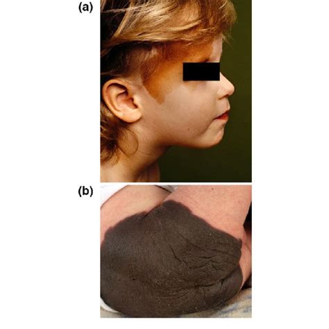 Congenital Melanocytic Naevi Of A Patient With Medium Size Naevi On The