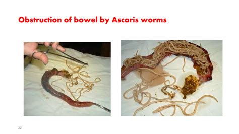 Ascaris Lumbricoides Ppt