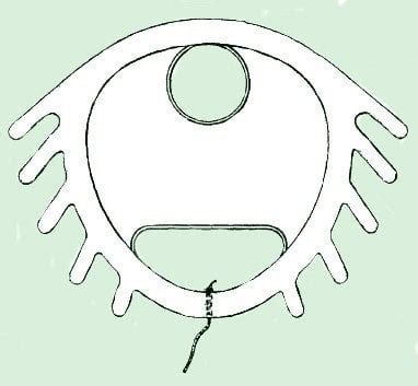 The Dalkon Shield was a contraceptive intrauterine device (IUD). It was ...