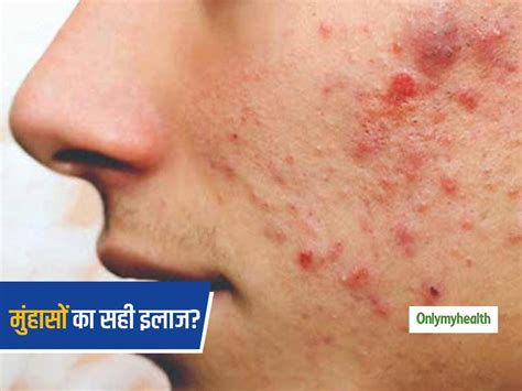 Do Not Use Home Remedies To Treat Pimples Acne And Scar Of Skin Know 4