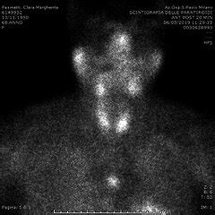 Tc M Sestamibi Scan Showing A Main Pathologic Increased Uptake On