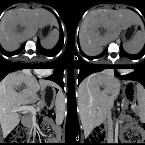 Coupes Axiales D Une Tomodensitom Trie Abdominale Avant Injection De