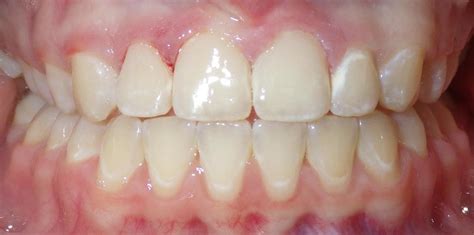 Cosmetic Dentist Duxbury Ma Cosmetic Bonding After Braces