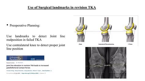 Surgical Landmarks In Revision Total Knee Ppt