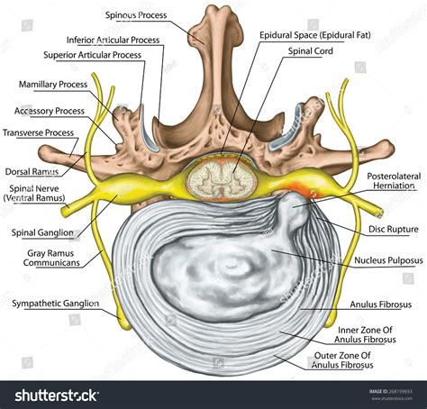 Lumbar Disk Herniation Herniated Disc Lumbar Stock Illustration