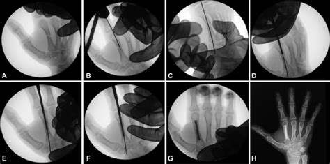 Percutaneous Osteosynthesis Technique With Cannulated Screws A Closed