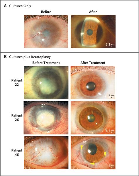 Limbal Stem Cell Therapy And Long Term Corneal Regeneration Nejm