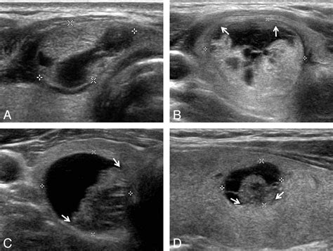 Thyroid Talk — Is A 2 Cm Thyroid Nodule Large