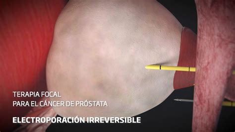 Terapia focal para el cáncer de próstata en el Centro de Próstata