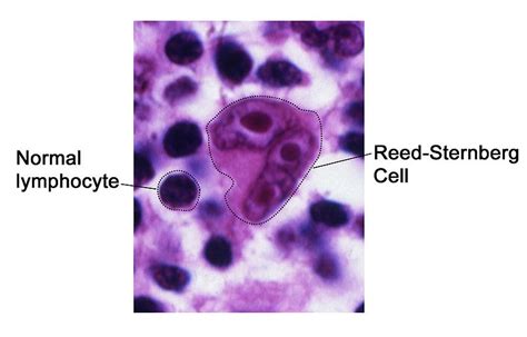 Medic Guide: What are Reed-Sternberg cells?