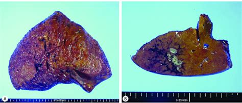 Gross Findings Of The Resected Liver A There Were No Grossly