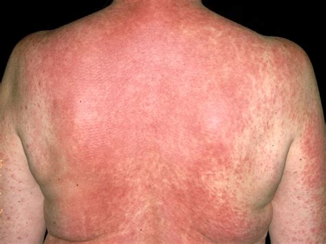 How Long Does A Drug Reaction Rash Last Allergy Differences