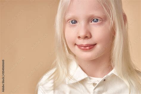 Caucasian Albino Eyes