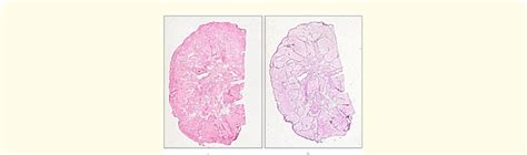 Legends to figure 5 (126/94). Synovial chondromatosis, contact ...