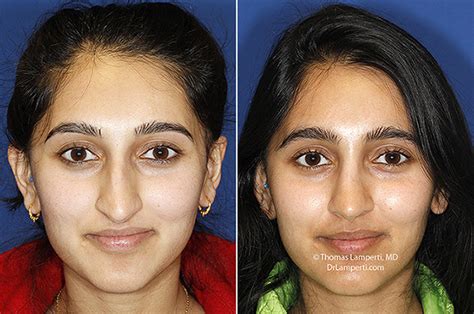 Crooked Nose Rhinoplasty In Seattle Rhinoplasty Surgeon