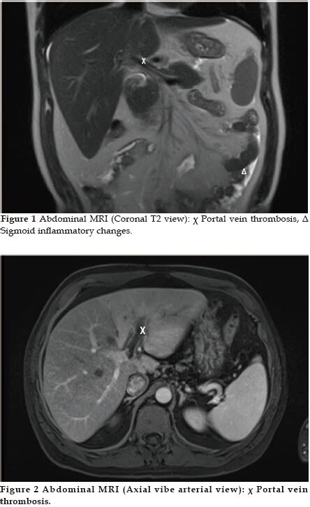 Splenic Vein Thrombosis