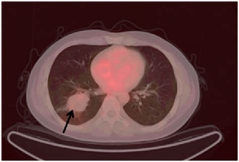 Figure 2 From Evaluation Of The Role Of 18F FDG PET CT And 68Ga