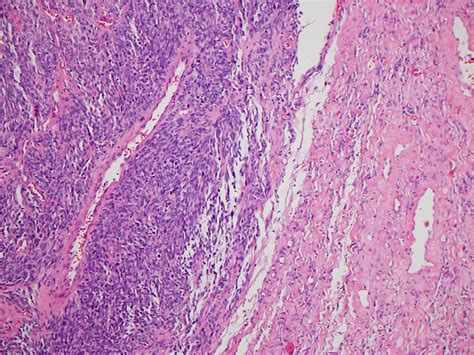 Pathology Outlines Solitary Fibrous Tumor