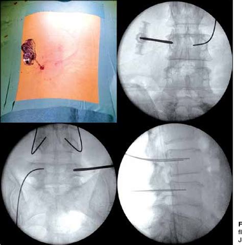 Figure From Minimally Invasive Transforaminal Lumbar Interbody Fusion