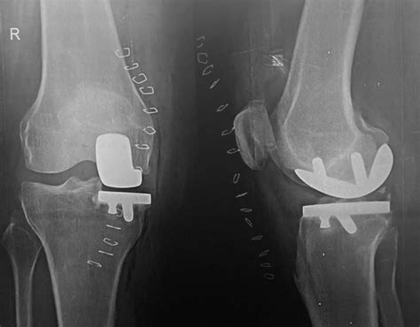 Partial Knee Replacement - DR.SANJEED PUJARY