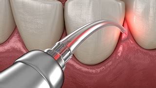 Soft Tissue Laser Lakeville | Advanced Technology | Southeastern Dental