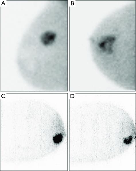 Heterogeneous Uptake Of M Tc Mibi In Invasive Ductal Breast Carcinoma