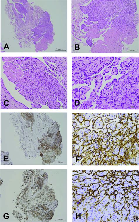 Histological And Immunostaining Microphotographs Of Our Case Of