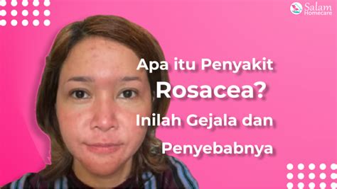 Apa Itu Penyakit Rosacea Inilah Gejala Dan Penyebabnya Salam Homecare