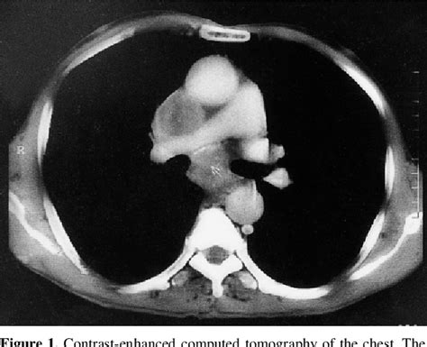 Figure 1 From Superior Vena Cava Syndrome Due To Metastatic