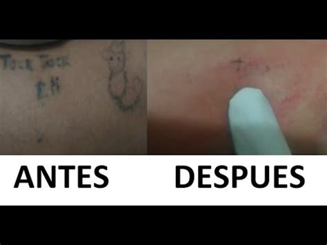 Como Quitar Un Tatuaje De Forma Casera Forma Efectiva Youtube