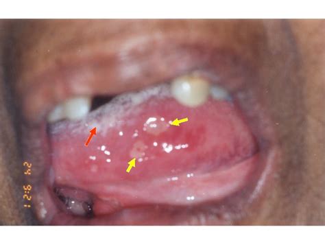 Stomatitis Tongue