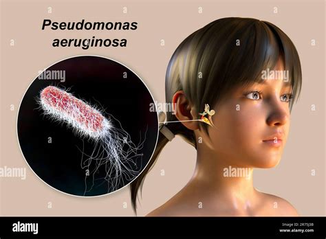 Pseudomonas Aeruginosa Bacterium Als Ursache Einer Otitis Media