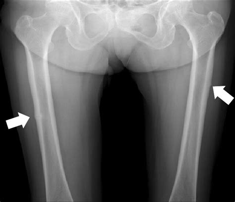 Right Femoral Stress Fracture And Left Femoral Stress Reaction Wiki