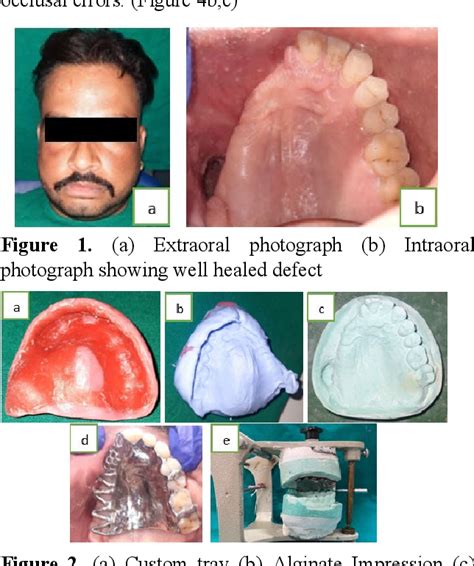 Figure From Rehabilitation Of Maxillary Defect Using Removable