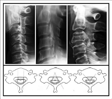 Classification Of Ossification Morphology Hill Plateau And Mushroom