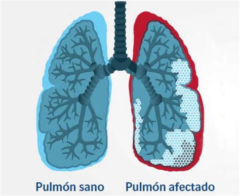 FIBROSIS PULMONAR IDIOPATICA PDF