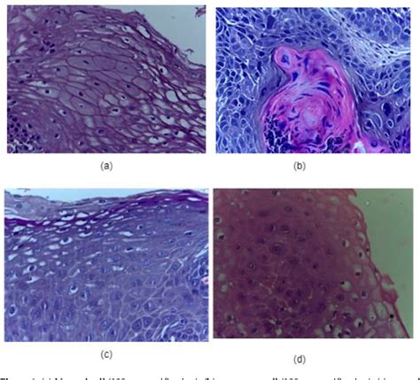 Figure 1 From Automatic Detection Of Oral Squamous Cell Carcinoma From Histopathological Images