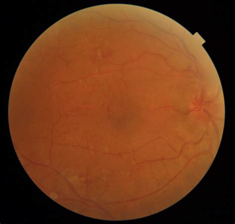 Overview Of Hypertensive Retinopathy Its Symptoms Causes Treatment