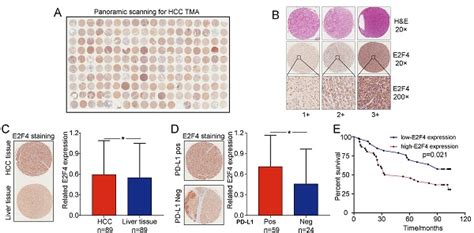 Transcription Factor E2f4 Is An Indicator Of Poor Prognosis And Is