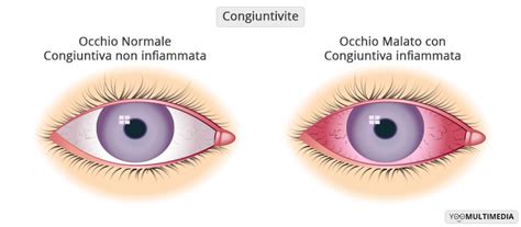 Congiuntivite Allergica Sintomi E Cure Centro Oculistico Poliambulanza