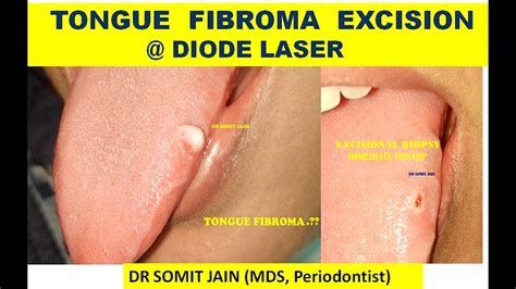 Tongue Fibroma Excision With Diode Laser I Dr Somit Jain Youtube