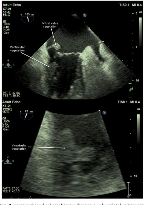 Figure From Aspergillus Endocarditis Of The Mitral Valve With