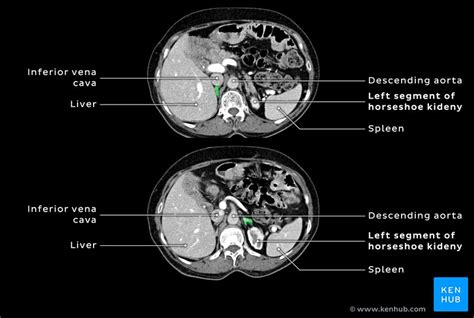 Horseshoe kidney transplantation: Anatomy and images | Kenhub