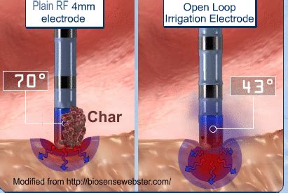 Wes Todd, RCIS, RCES: RF Ablation