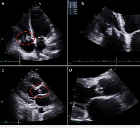 Transthoracic Echocardiogram Apical Four Chamber View A And Magnified