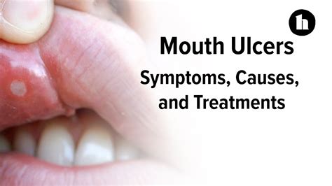 mouth ulcers symptoms diagnosis  treatments healthline youtube