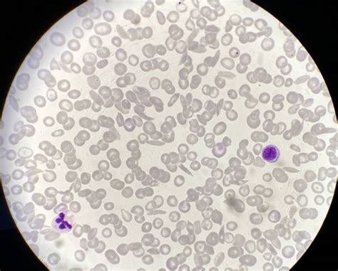 130+ Sickle Cell Microscope Stock Photos, Pictures & Royalty-Free Images - iStock