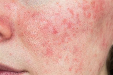 Rosacea Skin Disorder Or Systemic Disease Process Dermatology Advisor