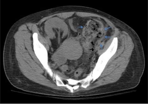 Not Your Usual Constipation Stercoral Perforation Bmj Case Reports