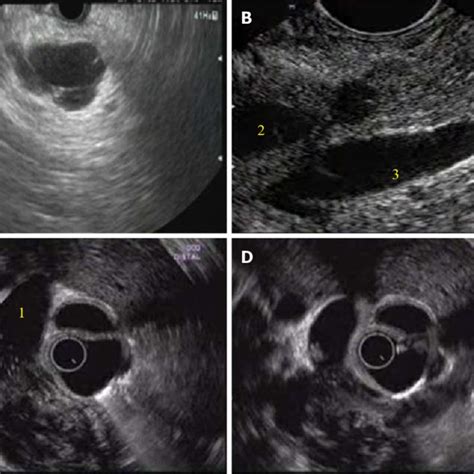 Endoscopic Ultrasound Appearance Of Mass Lesions In Pancreas A Serous Download Scientific